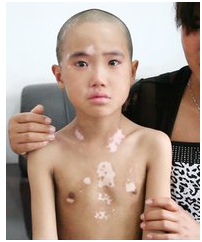 ��ͯ����֢״