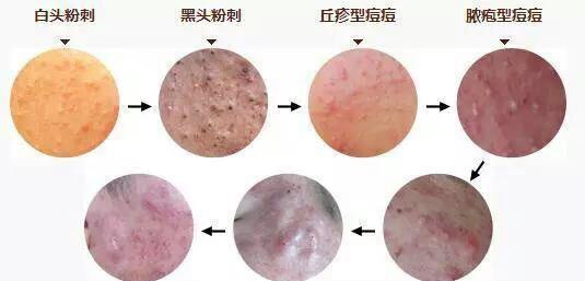 ���ݻ��н����ഺ�����������ͼ�֢״