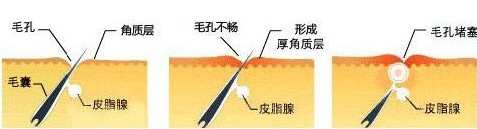 �ഺ������ô�γɵ�ԭ��